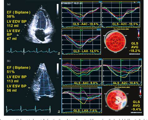 Ten Years of 2D Longitudinal Strain for Early Myocardial 